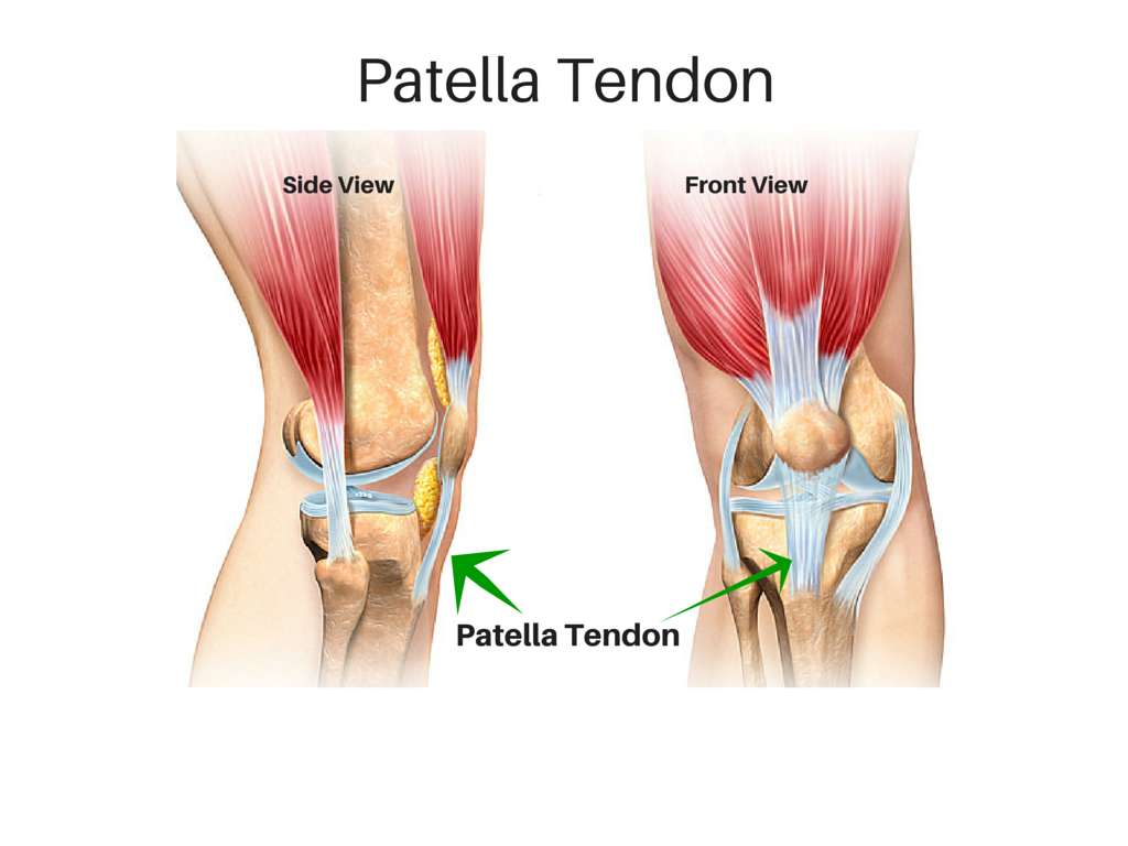 Ruptured patellar tendon